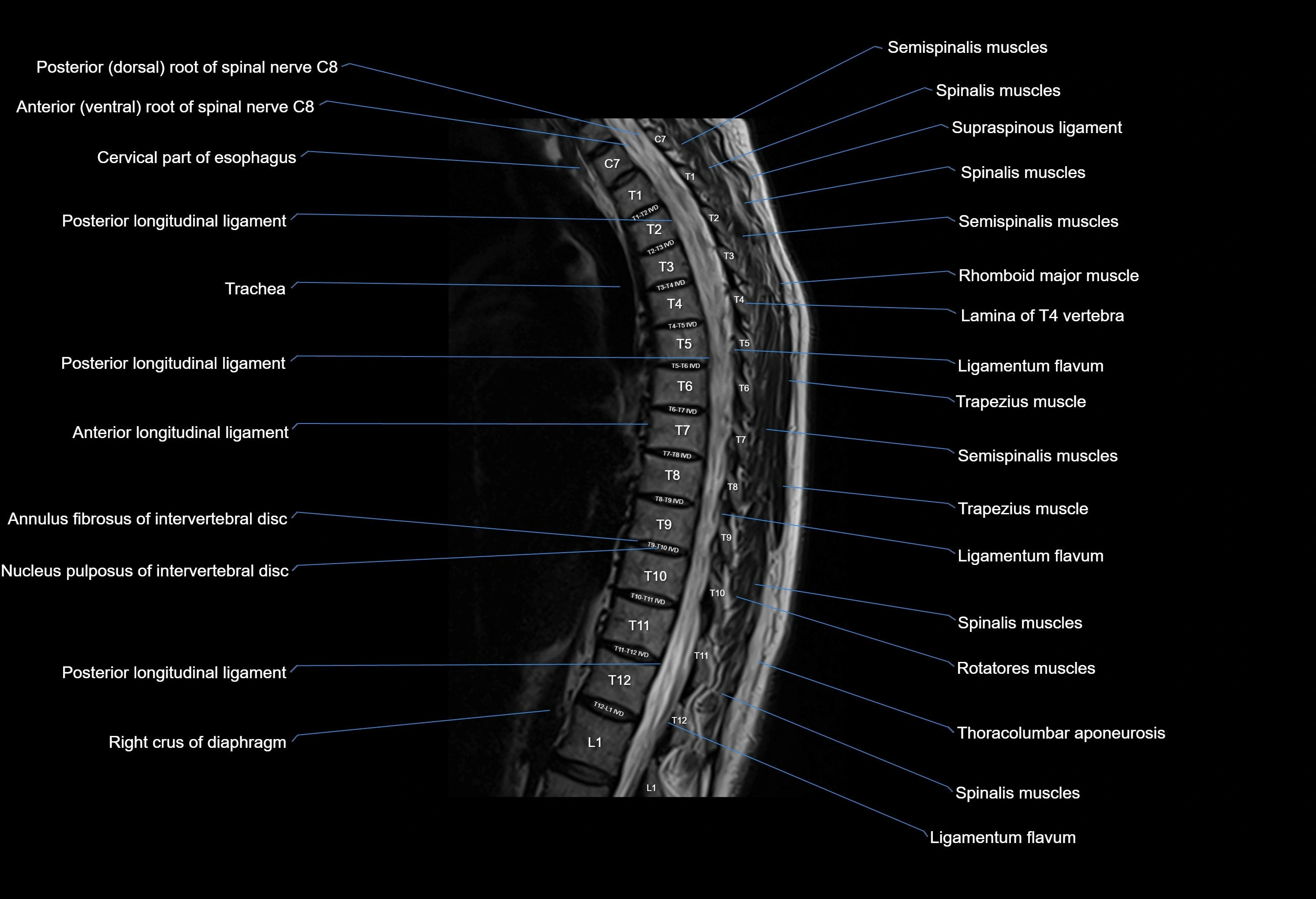 MRI thoracic spine sagittal  cross sectional anatomy 3T radiology  image-img-00001-00010.webp